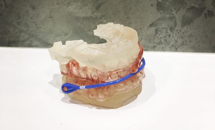 SomnoDent Avant Oral Appliance used to treat snoring